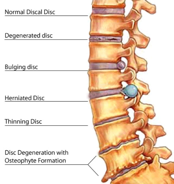 Disc Herniation